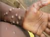 Monkeypox: संदिग्ध मरीज को अस्पताल से मिली छुट्टी, मंकीपॉक्स के क्या हैं लक्षण? जानें डॉक्टर्स से