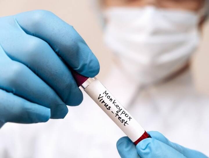 ਮੰਕੀਪੌਕਸ ਤੋਂ ਘਬਰਾਉਣ ਦੀ ਲੋੜ ਨਹੀਂ ਹੈ। ਇਹ ਕੋਵਿਡ-19 ਵਾਂਗ ਛੂਤਕਾਰੀ ਨਹੀਂ ਹੈ ਅਤੇ ਇਹ ਕੋਰੋਨਾ ਵਾਇਰਸ ਜਿੰਨੀ ਤੇਜ਼ੀ ਨਾਲ ਨਹੀਂ ਫੈਲਦਾ ਹੈ।