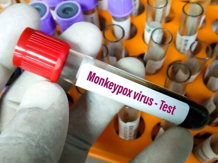 Telangana: Monkeypox Suspect In Kamareddy Tested Negative Telangana: Monkeypox Suspect In Kamareddy Tested Negative