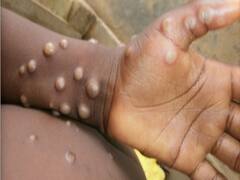Monkeypox vs Chickenpox: क्या एक जैसे हैं मंकीपॉक्स और चिकनपॉक्स के लक्षण? एक्सपर्ट से समझिए