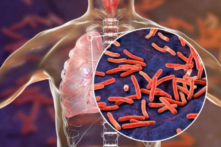 The number of deaths due to tuberculosis has increased in Trichy district திருச்சி மாவட்டத்தில் காசநோய் இறப்பு விகிதம் அதிகரிப்பு  - காரணம் என்ன..?