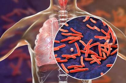 The number of deaths due to tuberculosis has increased in Trichy district திருச்சி மாவட்டத்தில் காசநோய் இறப்பு விகிதம் அதிகரிப்பு  - காரணம் என்ன..?