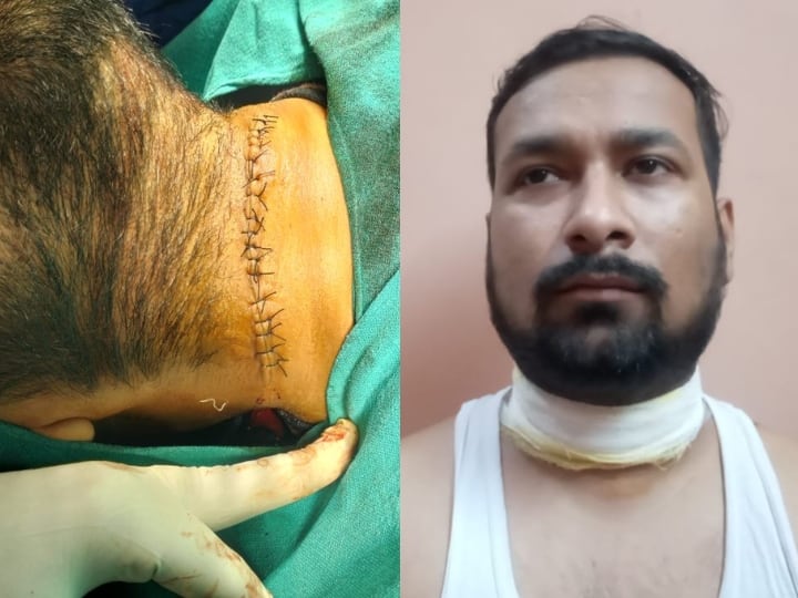 Man injured after being hit by Chinese manjha in Delhi got 12 stitches in his neck ANN Chinese Manjha: दिल्ली में चाइनीज मांझे ने एक और शख्स को बनाया अपना शिकार, गर्दन में आए 12 स्टिच