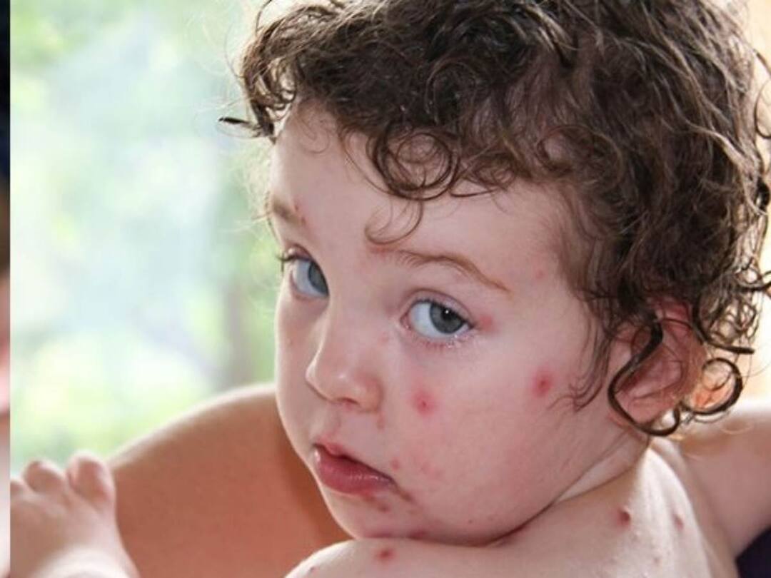 Tomato fever cases are increasing in children, which is not caused by eating tomatoes Tomato Fever: పిల్లల్లో పెరుగుతున్న టమోటో ఫీవర్ కేసులు, ఇది టమోటొలు తినడం వల్ల మాత్రం రాదు