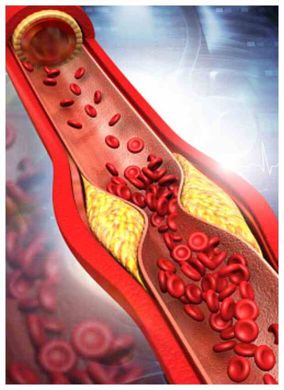 कोलेस्ट्रॉल बढ़ने पर क्या खाएं, क्या न खाएं?