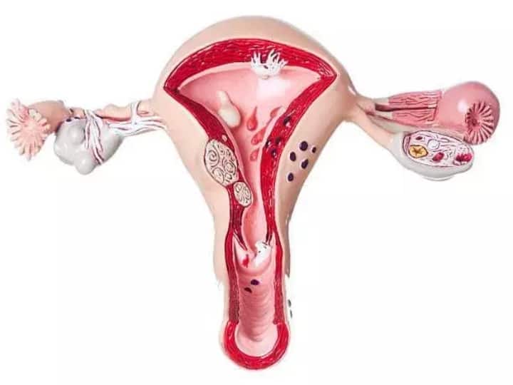 What is Endometriotic cyst? How it affects on fertility? பெண்களை தாக்கும் சாக்லேட் நீர்க்கட்டிகள்... அறிகுறிகள், சிகிச்சை மற்றும் காரணங்கள் என்ன?