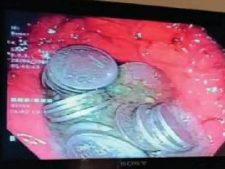 Rajasthan Doctors remove 63 coins from patient's stomach in two-day-long operation மன வருத்தத்தில் 63 ஒரு ரூபாய் நாணயங்களை விழுங்கிய நபர்... 2 நாட்களாக போராடிய மருத்துவர்கள்!