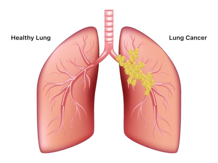 Why is World Lung cancer day celebrated on August 1st every year? Lung Cancer : இத்தனை மில்லியன் மக்கள் உயிரிழக்கிறார்களா? அதிகரிக்கும் நுரையீரல் புற்றுநோய்.. அதிர்ச்சி தகவல்..