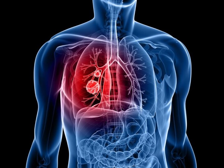 Lung Cancer : இத்தனை மில்லியன் மக்கள் உயிரிழக்கிறார்களா? அதிகரிக்கும் நுரையீரல் புற்றுநோய்.. அதிர்ச்சி தகவல்..