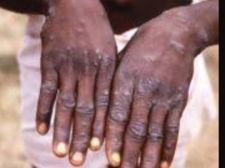 22 year old man died of moneky pox  symptoms in Kerala கேரளாவில் இளைஞர் உயிரிழப்பு: ஐக்கிய அரபு அமீரக சோதனையில் குரங்கம்மை உறுதி!