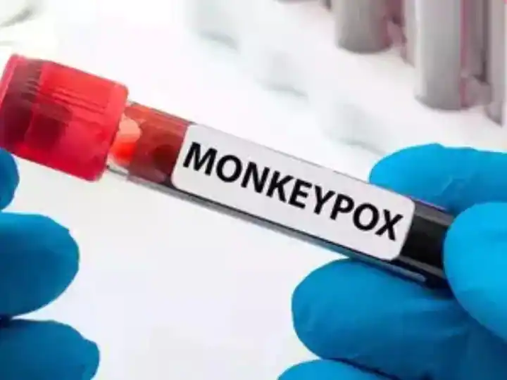 Monkeypox Suspected Dies: : Death of patient returned from UAE with monkeypox symptoms in Kerala, probe ordered Monkeypox Suspected Dies: : ਕੇਰਲ 'ਚ ਮੰਕੀਪੌਕਸ ਦੇ ਲੱਛਣਾਂ ਵਾਲੇ UAE ਤੋਂ ਪਰਤੇ ਮਰੀਜ਼ ਦੀ ਮੌਤ, ਜਾਂਚ ਦੇ ਹੁਕਮ