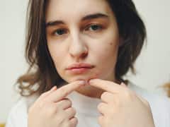 Pimples: మొటిమలతో ఇబ్బంది పడుతున్నారా? ఈ చిట్కాలతో చిటికెలో మటుమాయం!