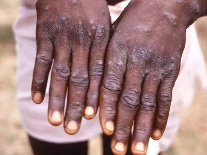 monkey pox vs chicken pox difference between the two disease Chicken pox VS Monkey pox:  குரங்கு அம்மை மற்றும் சின்னம்மை.. வித்தியாசம் என்ன? தெரிந்துகொள்ளவேண்டியது என்ன?