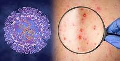 Monkeypox ਵਾਇਰਸ : Monkeypox ਇਕ ਵਾਇਰਸ ਜਾਂ ਇੱਕ ਬਿਮਾਰੀ? ਜਾਣੋ ਕੀ ਕਹਿਣਾ ਮਾਹਰਾਂ ਦਾ
