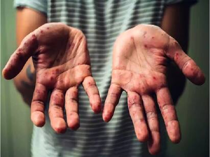Kerala New Monkeypox Case Reported in Malappuram Health Minister Veena George Monkeypox Case in Kerala: அதிர்ச்சியளிக்கும் அடுத்தடுத்த அறிகுறி... கேரளாவில் மேலும் ஒருவருக்கு குரங்கம்மை..!