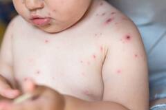 Monkeypox ਵਾਇਰਸ : Monkeypox ਇਕ ਵਾਇਰਸ ਜਾਂ ਇੱਕ ਬਿਮਾਰੀ? ਜਾਣੋ ਕੀ ਕਹਿਣਾ ਮਾਹਰਾਂ ਦਾ