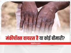 Monkeypox Virus : मंकीपॉक्स वायरस है या कोई बीमारी? क्या कहते हैं एक्सपर्ट