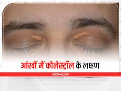 Cholesterol in Eyes : आंखों के ऊपर क्यों जमा हो जाता है कोलेस्ट्रॉल? जानें इसके लक्षण