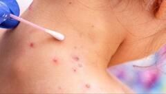 Monkeypox ਵਾਇਰਸ : Monkeypox ਇਕ ਵਾਇਰਸ ਜਾਂ ਇੱਕ ਬਿਮਾਰੀ? ਜਾਣੋ ਕੀ ਕਹਿਣਾ ਮਾਹਰਾਂ ਦਾ