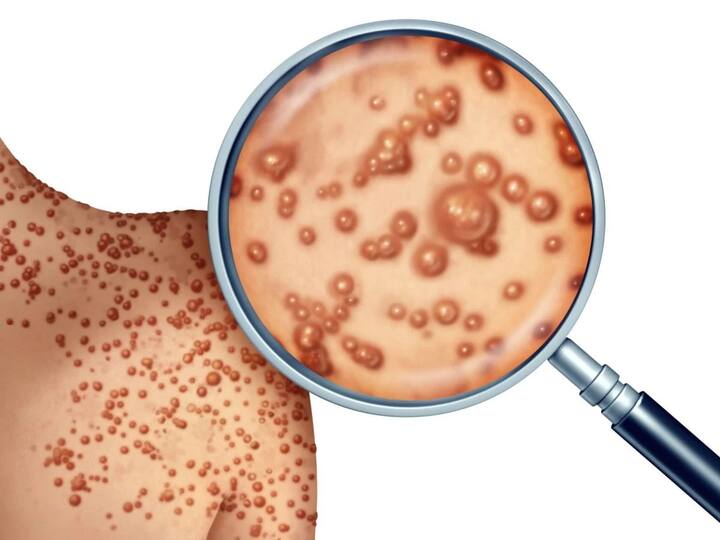 ਡਾਕਟਰ ਦਾ ਕਹਿਣਾ ਹੈ ਕਿ ਮੰਕੀਪੌਕਸ ਵਾਇਰਸ ਬਾਰੇ ਪੂਰੀ ਜਾਣਕਾਰੀ ਲਈ ਅਜੇ ਹੋਰ ਖੋਜ ਦੀ ਲੋੜ ਹੈ। ਫਿਲਹਾਲ ਇਸ 'ਤੇ ਕਈ ਖੋਜਾਂ ਹੋ ਰਹੀਆਂ ਹਨ।