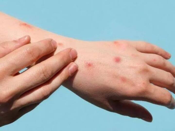 Monkeypox: In Bengaluru's Guidelines, At Least 21-Day Isolation For Case Monkeypox: பரவி வரும் குரங்கு அம்மை நோய் ! 21 நாட்கள் தனிமைப்படுத்த  கர்நாடக அரசு உத்தரவு!