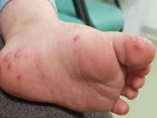 लहान मुलांच्या हात-पाय-तोंडाला फोड्या; मुंबई, ठाण्यात Hand Foot Mouth Disease चा संसर्ग वाढला