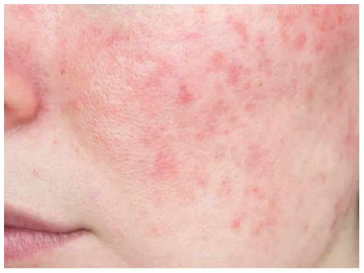Rosacea Causes Symptoms And Treatment Skin Redness What Is Rosacea Skin Care: चेहरे पर लाल निशान कहीं रोजेशिया के लक्षण तो नहीं, जानिए क्या है इसका इलाज