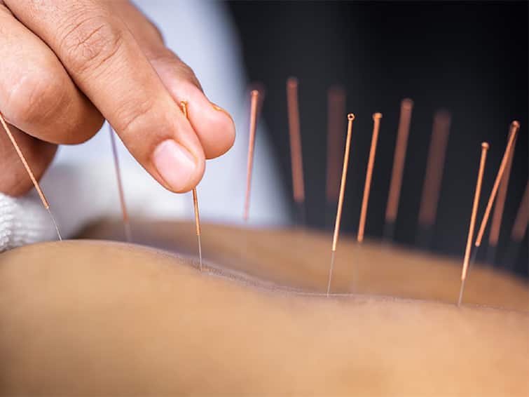 Acupuncture Can Help Ward Off Diabetes, Says Study நீரிழிவு நோயிலிருந்து விடுபட அக்குபங்சர் மருத்துவ முறை... தெரிந்து கொள்ள வேண்டியது என்ன?