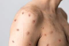 Monkey Pox: মাঙ্কি পক্সে ভয় নয়, মেনে চলুন এই নিয়মগুলি