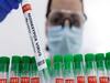Monkeypox : భద్రాద్రి కొత్తగూడెం జిల్లాలో మంకీపాక్స్ కలకలం, విద్యార్థిలో లక్షణాలు గుర్తింపు!