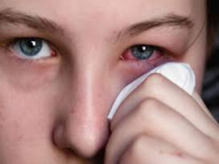 Dry Eye Syndrome : கண் வறண்டு போகுதா? எரிச்சல் இருக்கா? இந்த அறிகுறிகள் இதற்கானதா? எச்சரிக்கை..