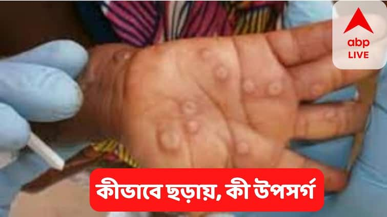 Monkeypox  9  Cases in India, know its symptoms, treatments Monkeypox :  দিল্লি পৌঁছে গেছে মাঙ্কি পক্স, এই তথ্যগুলি না জানলে বাড়বে আপনার ঝুঁকি !