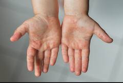 Monkeypox US: अमेरिका के टेक्सास में दुर्लभ ‘मंकीपॉक्स’ का पहला मामला दर्ज, 20 सालों में पहली बार हुआ ऐसा