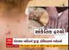 Monkeypox Threat : જામનગરમાં યુવકને મંકીપોક્સના લક્ષણ જોવા મળતા તંત્ર થઈ ગયું દોડતું