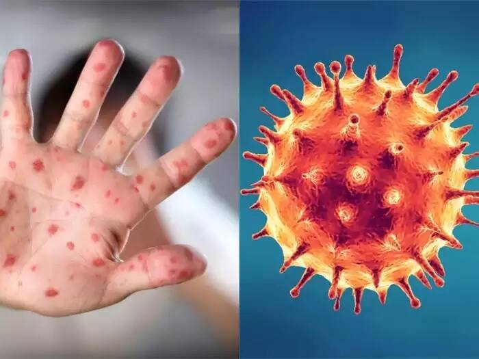 Monkeypox vs Corona: Know what is different between monkeypox and corona and how its spread Monkeypox vs Corona: મંકીપોક્સ અને કોરોનામાં શું છે અંતર, બંને રોગ કેવી રીતે ફેલાય છે, જાણો જરૂરી વાતો