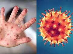 Monkeypox vs Corona: મંકીપોક્સ અને કોરોનામાં શું છે અંતર, બંને રોગ કેવી રીતે ફેલાય છે, જાણો જરૂરી વાતો