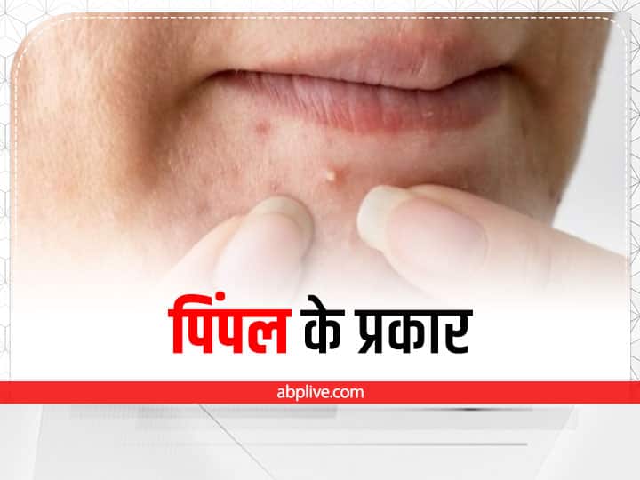 skin care tips sensitive skin control pimple problem types of pimple cause of pimple Types of Pimple: कितने तरह के होते हैं पिंपल और क्या है इनके कारण