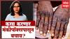 Remedies on Monkeypox : मंकीपॉक्सपासून वाचायचंय? करायचं काय? कसा करणार बचाव? ABP | Fitness Majha