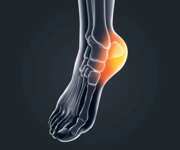 Heel pain causes reasons why you feel pain in the ankles while walking Heel Pain Causes: ચાલતી વખતે એડીમાં થાય છે અસહ્ય દુખાવો? આ હોય છે પેઇનનું મુખ્ય કારણ