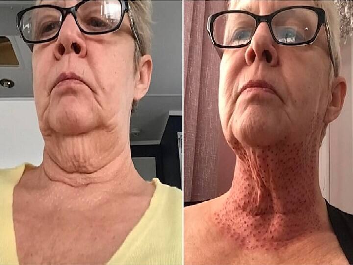 Woman left with ‘lizard neck’ after skin-tightening procedure goes wrong அழகு சிகிச்சைக்கு வந்தவருக்கு பல்லி தோல் தோற்றம்.. என்ன ஆச்சு தெரியுமா? உஷார்