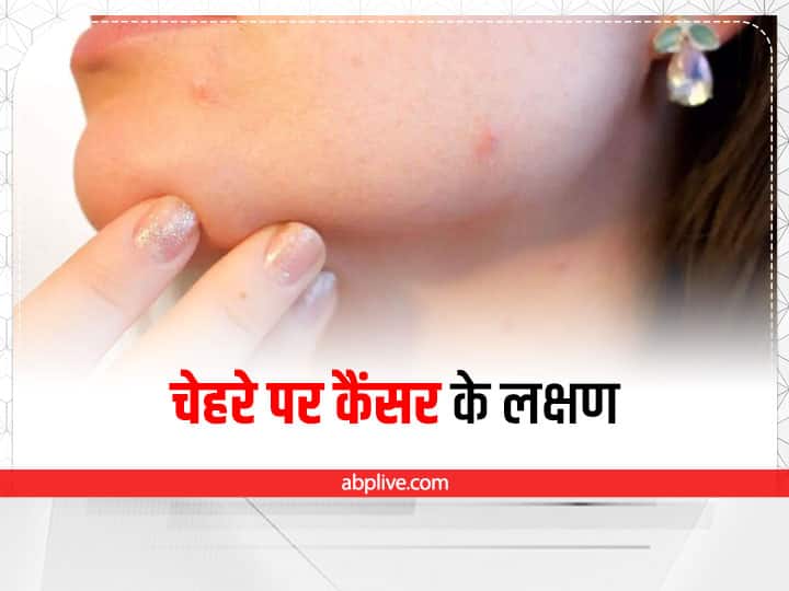 Skin cancer warning signs and symptoms in hindi Health News: चेहरे पर भी दिखते हैं कैंसर के लक्षण, इन संंकेतों से करें पहचान