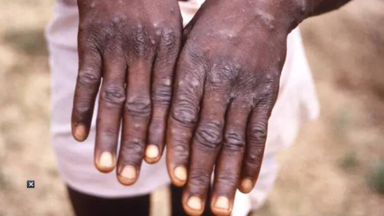 African Woman With Travel History To Nigeria Tests Positive For Monkey Pox In Delhi With Infection Toll Reaching 5 Monkey Pox: দিল্লিতে ফের মাঙ্কিপক্স, নাইজেরিয়া-ফেরত তরুণীর দেহে মিলল সংক্রমণ