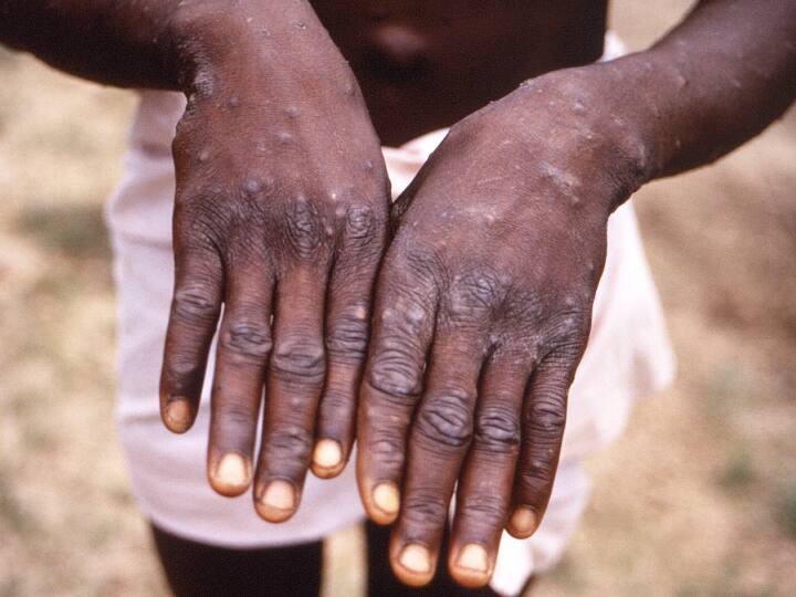 Monkeypox Name Change world health organization changed monkeypox s name to mpox Marathi News Monkeypox: 'मंकीपॉक्स' आजाराचं नाव बदललं; आता MPOX नवं नाव, WHO ची घोषणा