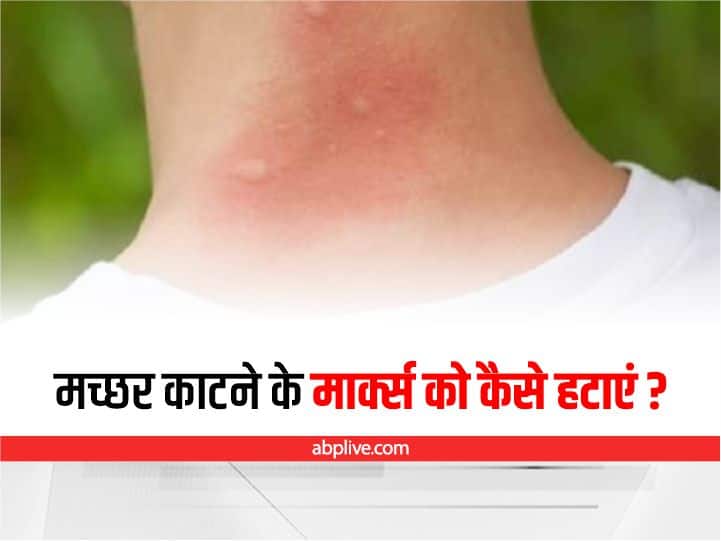 how to get rid of mosquito bite marks Health News मलेरिया, डेंगू ही