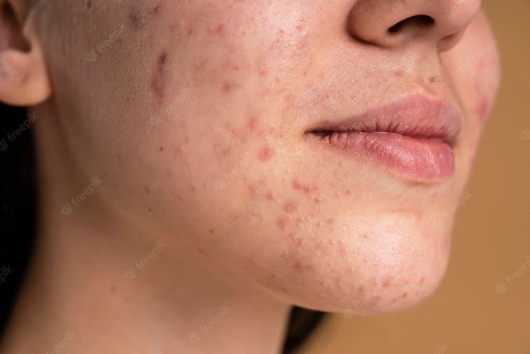 Taking antibiotics to clear acne affects bone growth Study: मुंहासों का एंटीबायोटिक दवाओं से जो कनेक्शन मिला है....वो हड्डियों की ग्रोथ रोक देगा