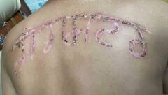 ਪੰਜਾਬ ਪੁਲਿਸ ਦਾ ਅਣਮਨੁੱਖੀ ਵਤੀਰਾ! ਕੈਦੀ ਦੀ ਪਿੱਠ 'ਤੇ ਗਰਮ ਰਾਡ ਨਾਲ ਲਿਖਿਆ 'ਗੈਂਗਸਟਰ'