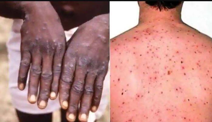 Monkeypox Vaccine is not 100 percent Effective says Who Monkeypox Cases in india Monkeypox : ਕੀ ਮੌਂਕੀਪੌਕਸ ਦੀ ਵੈਕਸੀਨ 100 ਪ੍ਰਤੀਸ਼ਤ ਪ੍ਰਭਾਵਸ਼ਾਲੀ ਨਹੀਂ ? WHO ਨੇ ਬੀਮਾਰੀ ਨੂੰ ਲੈ ਕੇ ਕੀਤੇ ਇਹ ਵੱਡੇ ਖੁਲਾਸੇ