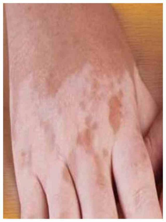 स्किन पर सफेद दाग कैसे करें कम? अपनाएं ये टिप्स