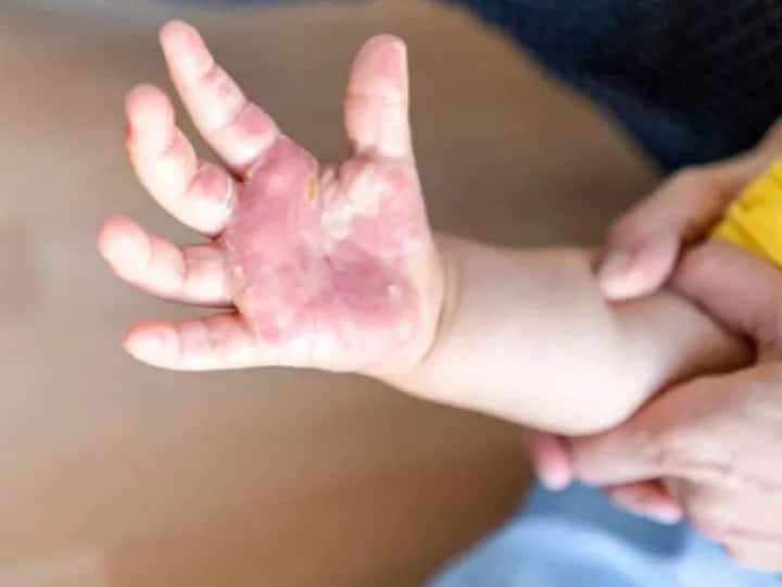 the lancet study said children are more risk if don t controlled also will spreading to adults Tomato Flu Study : टोमॅटो फ्लूला रोखलं नाही तर प्रौढांमध्ये संक्रमण होईल, लँसेट जर्नलचा इशारा