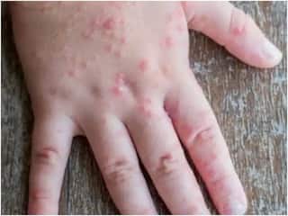 Tomato Flu : सावधान! कोरोना आणि मंकीपॉक्सनंतर आता 'टोमॅटो फ्लू' चा वाढतोय धोका; 'अशी' घ्या काळजी